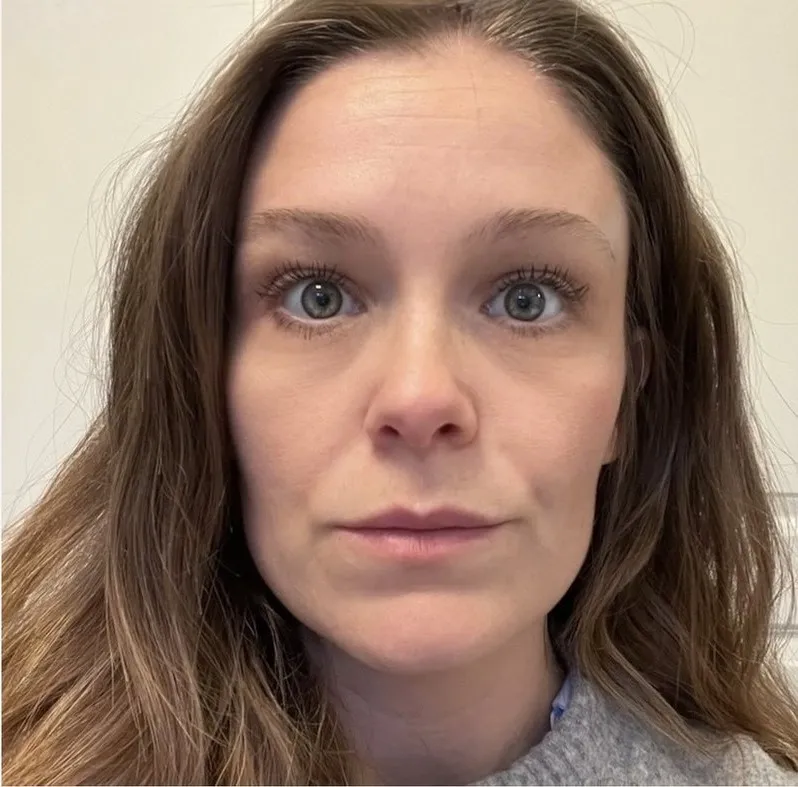 Øjenparti før og efter botox-brynløft — efter behandling