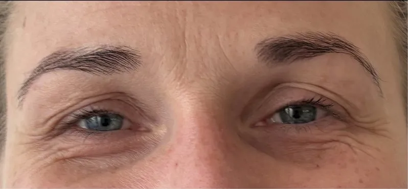 Bryn og øjenlåg før og efter botox-brynløft — før behandling