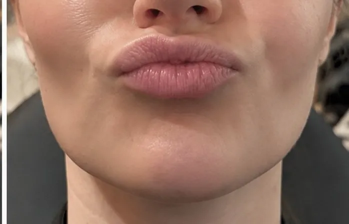 Hage før og efter Botox i mentalis-musklen — efter behandling