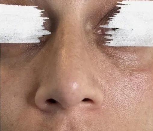 Næse før og efter nose slimming med Botox — før behandling