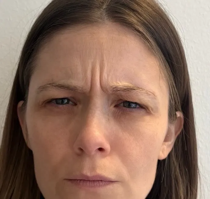 Bekymringslinjer mellem brynene — Botox — før behandling