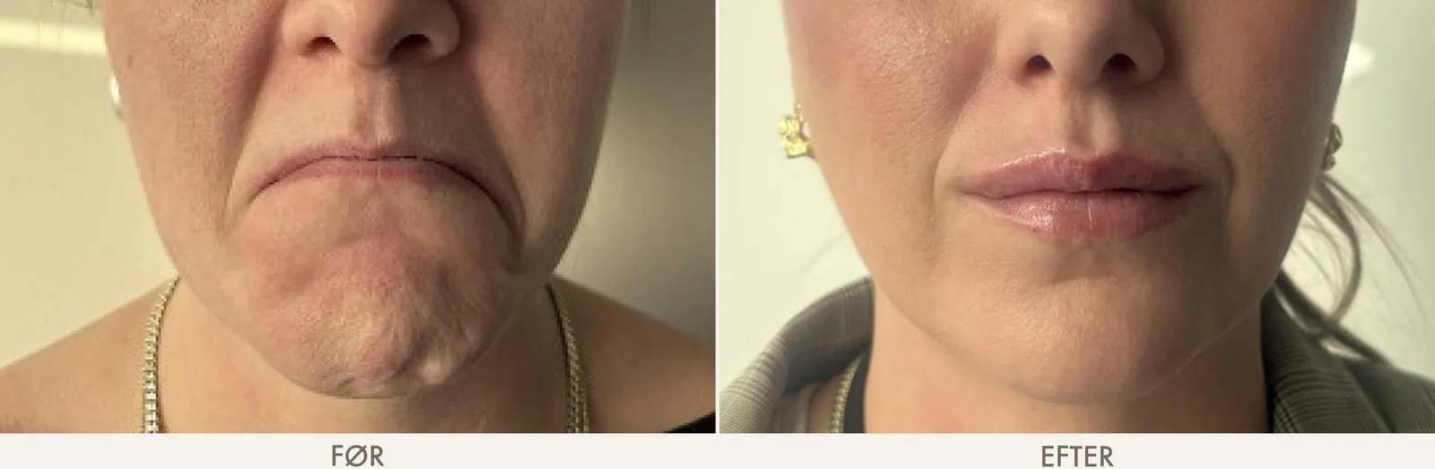 Mundvige før og efter Botox i DAO-musklen