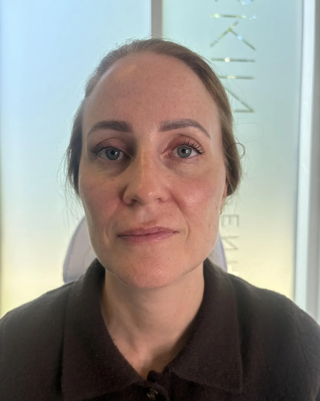 Midtkind og kindben set forfra — fillerbehandling — efter behandling
