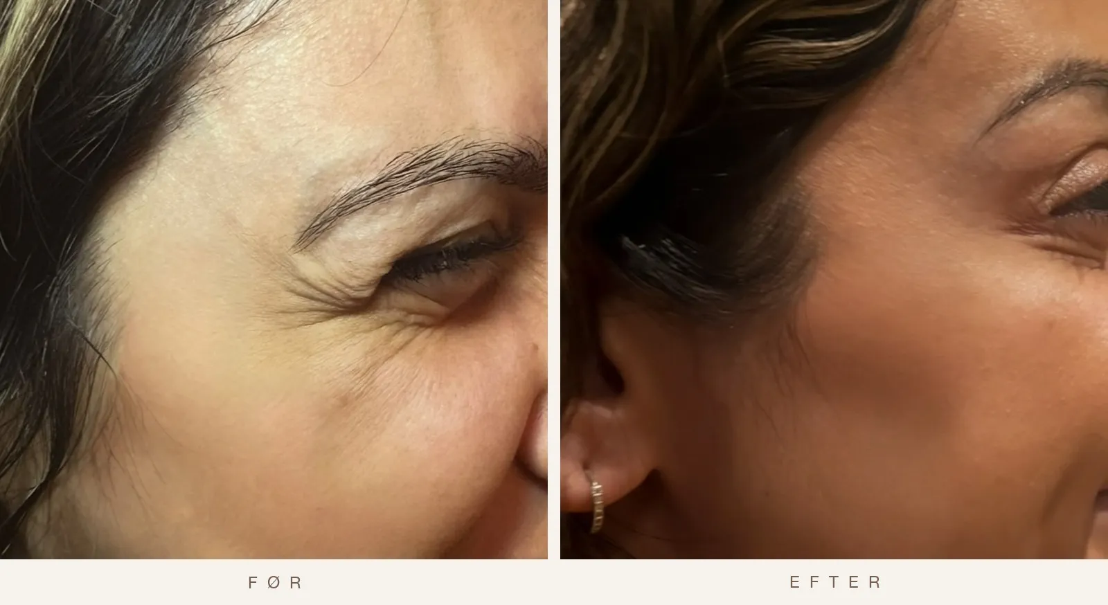 Øjenkrogen med kragetæer før og efter Botox