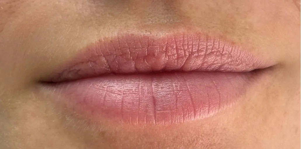 Læber set forfra — filler — før behandling