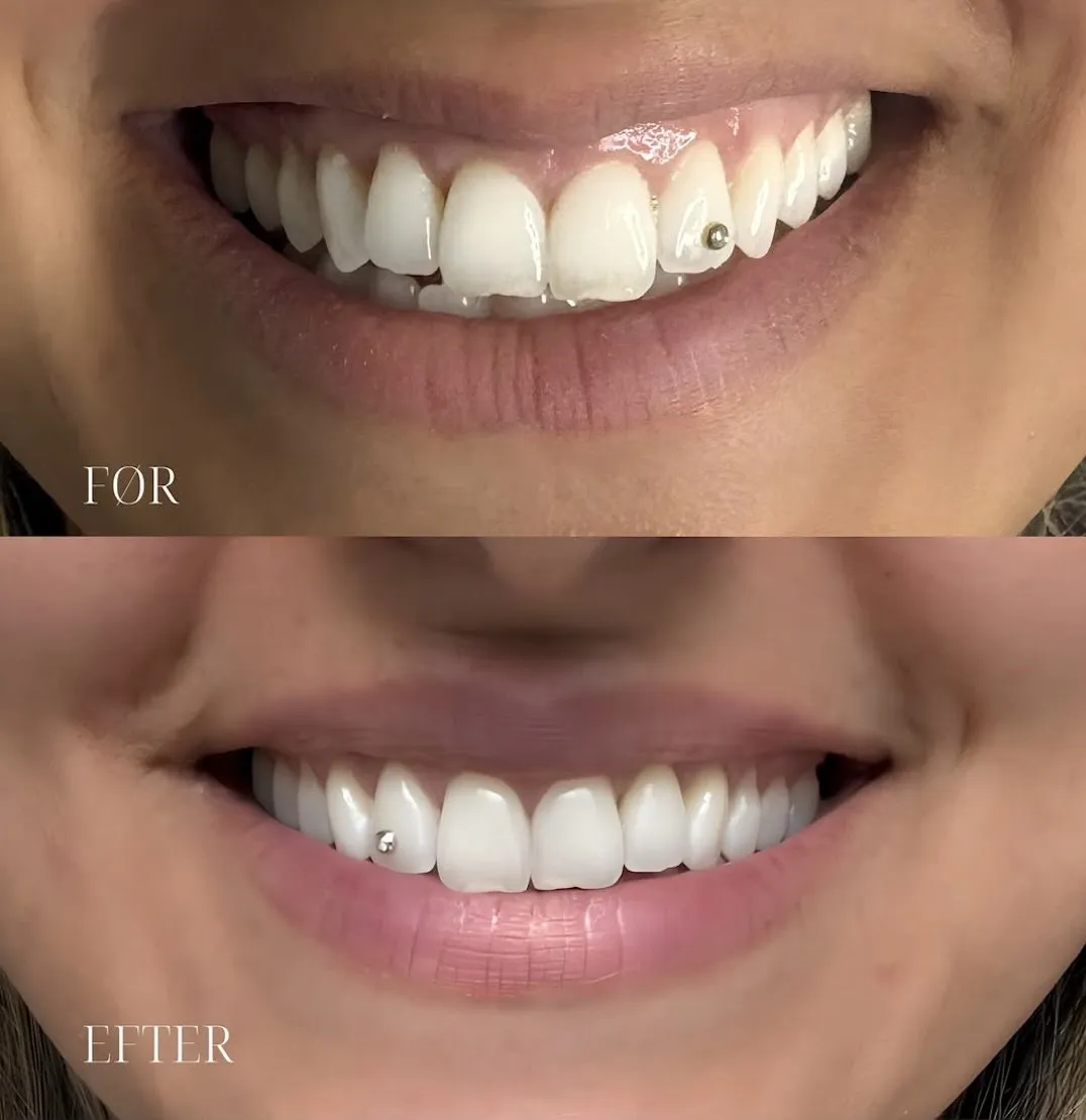 Smil før og efter lip flip med Botox