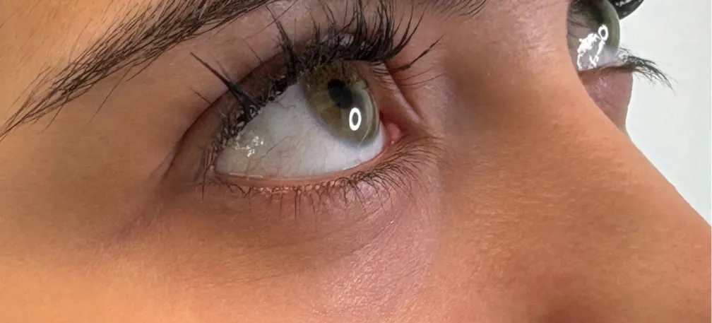 Underøjenområdet — tear trough-filler — før behandling